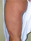 Skin Tightening
