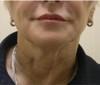 Skin Tightening