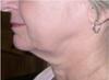 Skin Tightening