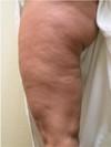 Skin Tightening
