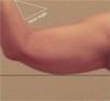 Skin Tightening