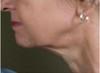 Skin Tightening