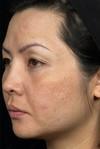 Laser Skin Treatments