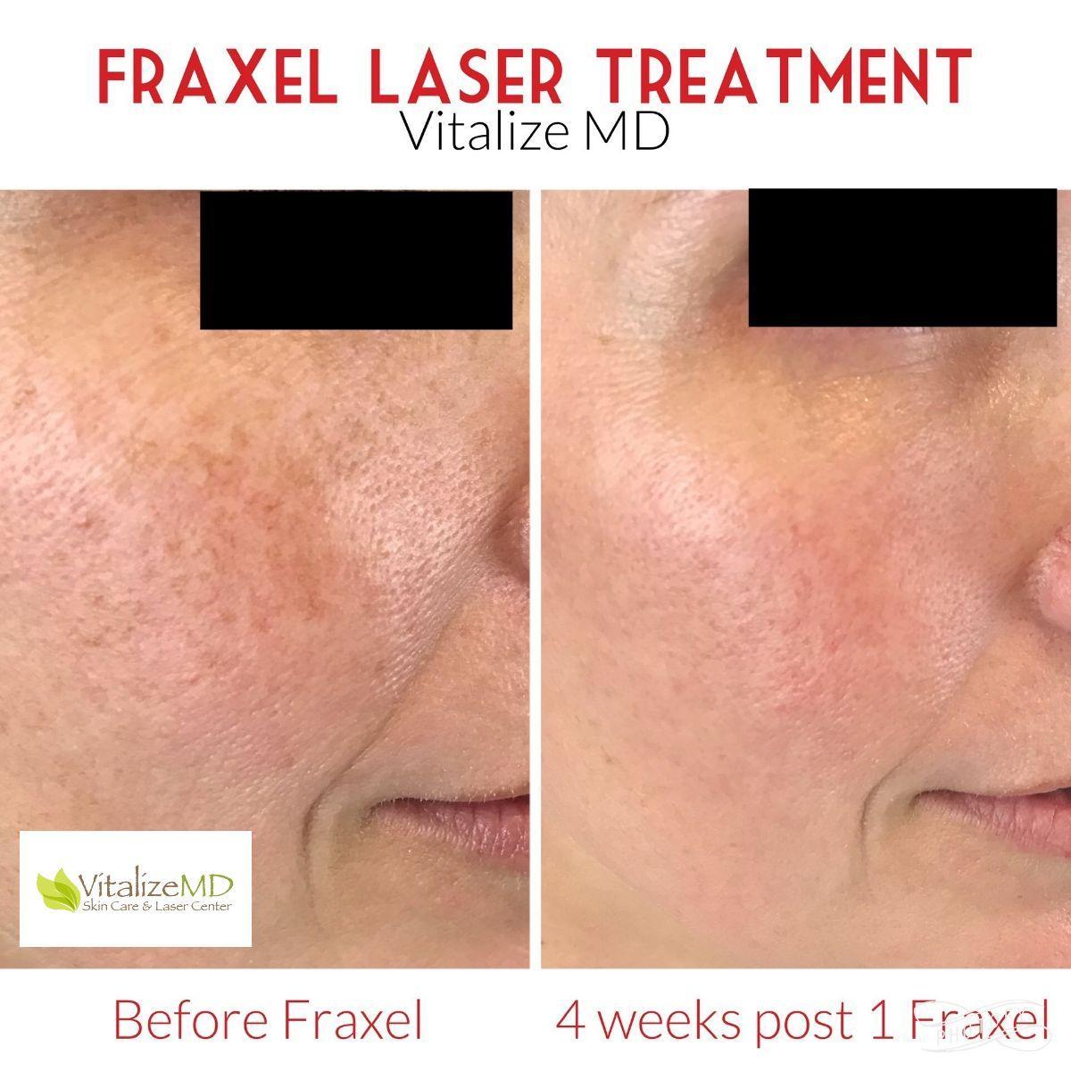 Fraxel