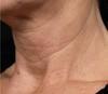 Laser Skin Treatments