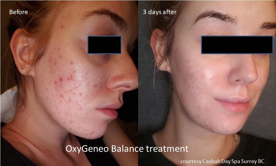 OxyGeneo Facial