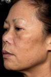 Laser Skin Treatments
