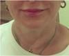 Skin Tightening
