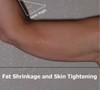 Skin Tightening