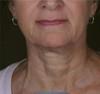 Skin Tightening