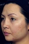 Laser Skin Treatments