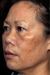 Laser Skin Treatments
