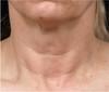 Laser Skin Treatments