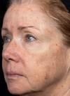 Laser Skin Treatments