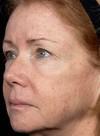 Laser Skin Treatments