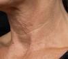 Laser Skin Treatments