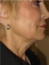 Skin Tightening