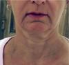 Skin Tightening