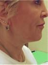 Skin Tightening